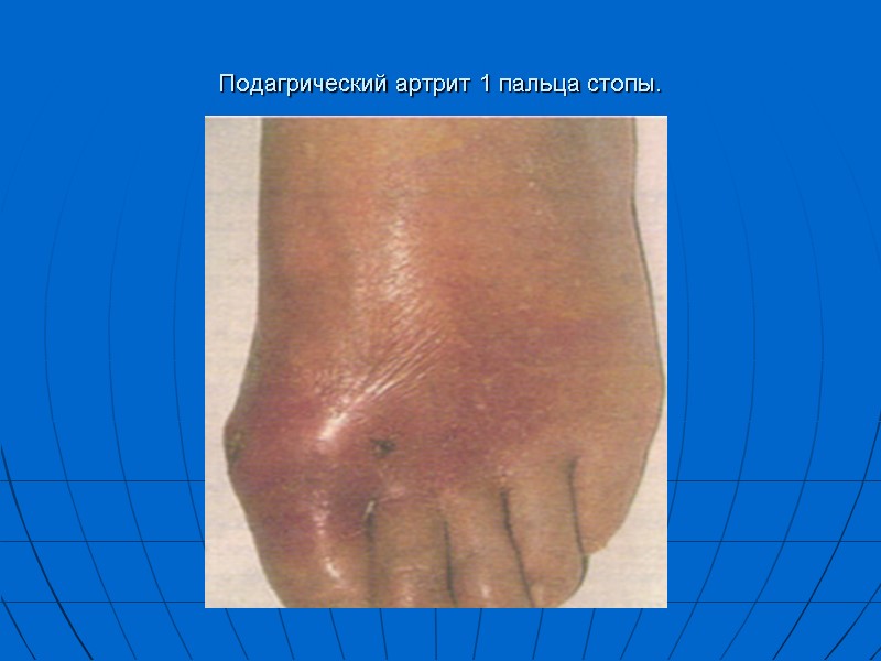 Подагрический артрит 1 пальца стопы.